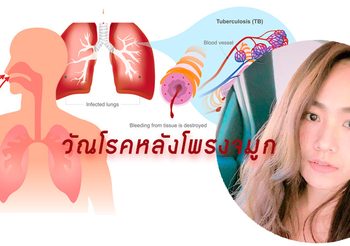 โรควัณโรคหลังโพรงจมูก เป็นวัณโรคชนิดที่ติดต่อกันได้น้อย พบเพียง 1%