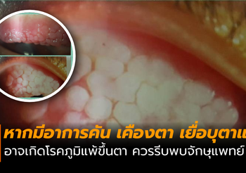 หมอเตือน! หากคันตา เคืองตา อาจเกิดโรคภูมิแพ้ขึ้นตา ควรรีบพบจักษุแพทย์