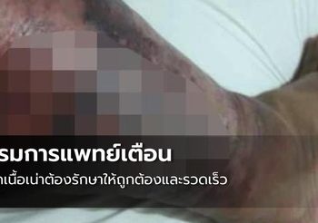 กรมการแพทย์เตือนโรคเนื้อเน่าต้องรักษาให้ถูกต้องและรวดเร็ว