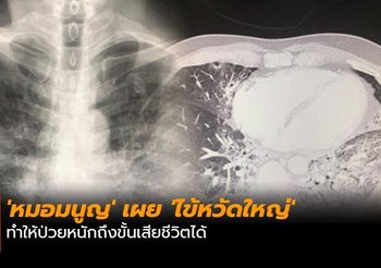 ‘หมอมนูญ’ เผย ‘ไข้หวัดใหญ่’ ทำให้ป่วยหนักถึงขั้นเสียชีวิตได้
