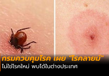 โรคลายม์ ไม่ใช่โรคใหม่! แนะผู้เดินทางไปต่างประเทศ ระมัดระวังถูกเห็บกัด