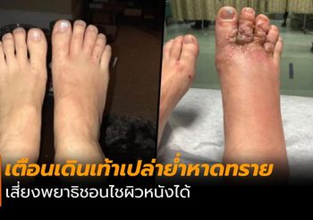 เพจดังเตือนระวัง ถอดรองเท้าเดินหาดทราย เสี่ยงพยาธิชอนไชผิวหนัง