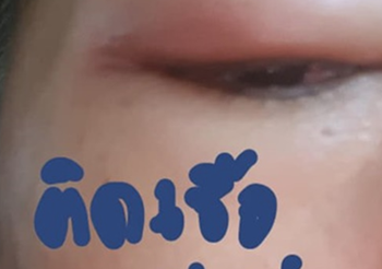 อุทาหรณ์สาวหวิดตาบอด เพราะเห็บเกาะบริเวณดวงตา !