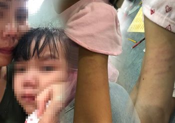 “ครูว่าหนูโง่ หนูไม่มีสมอง” หนูน้อย 5 ขวบ บอกแม่หลังถูกครูตีจนช้ำ