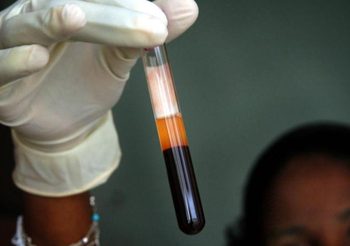 นักวิทยาศาสตร์ค้นพบเชื้อ HIV สายพันธุ์ใหม่ครั้งแรกในรอบ 19 ปี