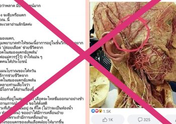 ยันแล้วไม่จริง! เจาะนิ้วช่วยชีวิต ป่วยเส้นเลือดสมองแตก