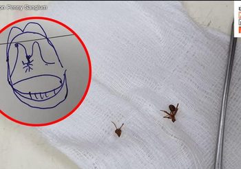 แปลกแต่จริง หมอเข้าช่วยผู้ป่วย หลังถูกมดกัดลิ้นไก่
