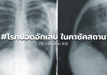 โรคปอดอักเสบไม่ทราบสาเหตุ ในคาซัคสถาน – (ล่าสุด 12 ก.ค.63)