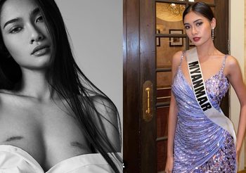 มิสยูนิเวิร์สพม่า โพสต์ภาพรอยแผลเป็น จากการผ่าตัดมะเร็งเต้านม