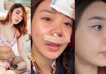 หญิงแย้ แชร์ประสบการณ์ จมูกติดเชื้อ หลังเสริมซี่โครงเทียม แบบละเอียดทุกอาการและวิธีรักษาอย่างถูกต้อง