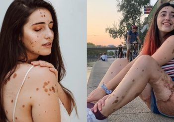 หญิงสาวผู้โตมากับคำบูลลี่ สู่การพบวิธีหาความสุขกับร่างกายตัวเอง ที่มีไฝบนตัวกว่า500เม็ด