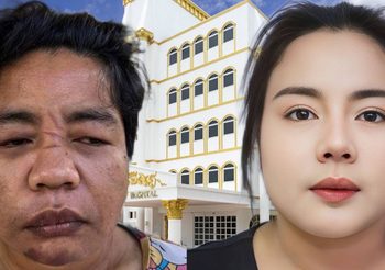 โรงพยาบาลเอเซียโชว์ผลงาน ระดมทีมแพทย์แก้ไขใบหน้า “น้องเอ” สวยออร่าราวกับเกิดใหม่ หลังถูกทารุณเสียโฉม