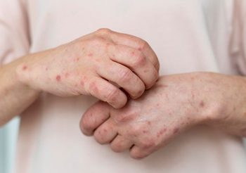 ภูมิแพ้อากาศกับผิวหนัง : เกี่ยวข้องกันอย่างไร?