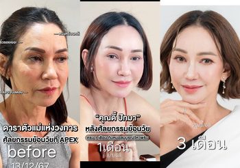 ปังมากแม่ “ดี้ ปัทมา” อัพเดทดึงหน้า ครบ 3 เดือน สวยจนคนทัก!