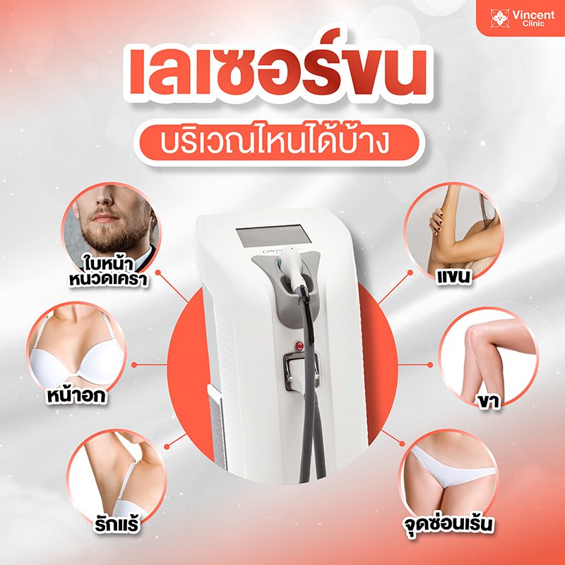 เลเซอร์ขน