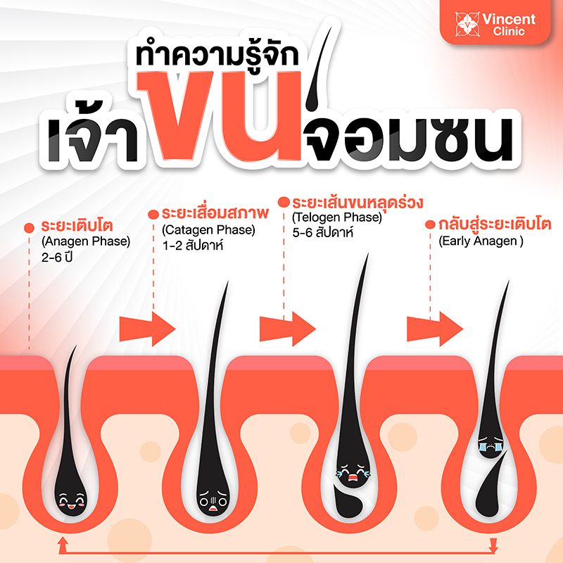 เลเซอร์ขน