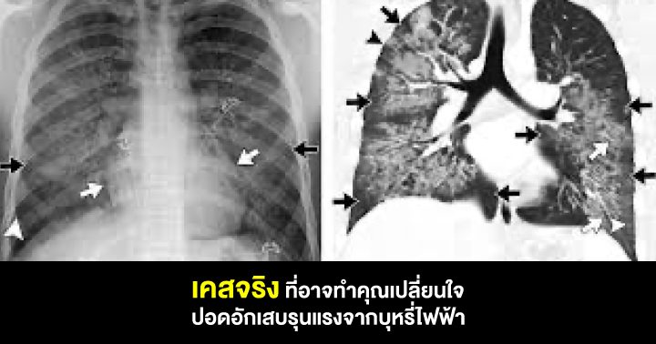 สูบพอด