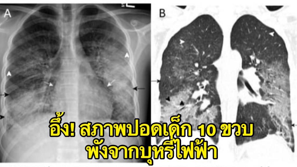 ปอด