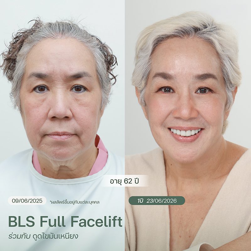 ผลลัพธ์โปรแกรม BLS Full Facelift ร่วมกับดูดไขมันเหนียง