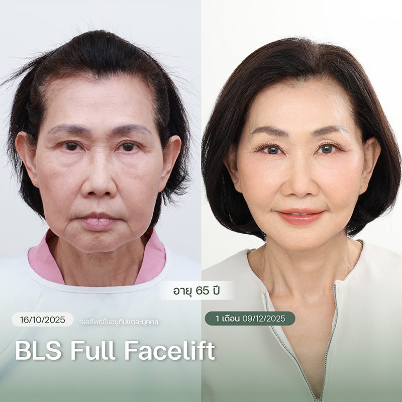 ผลลัพธ์โปรแกรม BLS Full Facelift