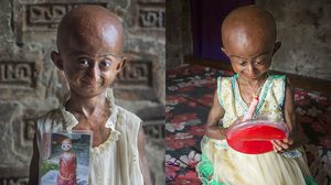 เด็กหญิง 10 ขวบ คิดบวก แม้ป่วยเป็นโรคชรา และมีชีวิตอยู่ได้อีกแค่ 3 ปี