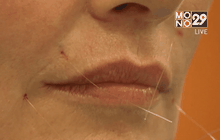 เทคนิคร้อยไหมยกกระชับใบหน้า