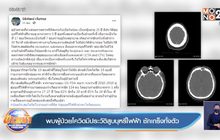 พบผู้ป่วยโควิดมีประวัติสูบบุหรี่ไฟฟ้า ชักเกร็งทั้งตัว
