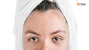 สิวขึ้น เพราะเครียด สาเหตุการเกิดสิว ที่สาวๆ มองข้าม ยิ่งเครียดยิ่งเห่อ รับมือยังไงดี