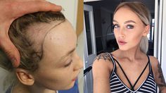 เตือน! สาวที่ชอบรวบผมตึงทุกวัน วันหนึ่งคุณอาจต้อง ปลูกผม เหมือนเธอคนนี้