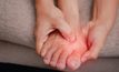 รู้จัก “นิ้วโป้งเท้าเก” (Hallux Valgus) เวลาใส่รองเท้าก็เจ็บ รักษาได้ไหม?