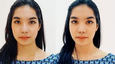 รีวิว คางสวยๆ ปรับรูปหน้า เห็นผลทันที ด้วย ฟิลเลอร์