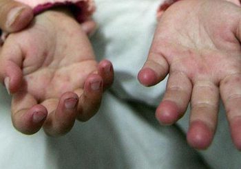 กรมควบคุมโรค เตือนดูแลเด็กเล็กอายุ 1-3 ปี ระวังป่วยโรคมือ เท้า ปาก