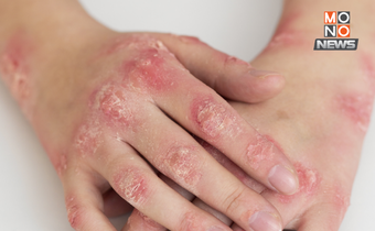 แอนแทรกซ์คร่าชีวิตที่มุกดาหาร เฝ้าระวังพื้นที่ดอนตาล