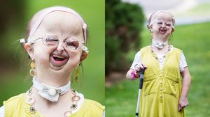 หญิงสาววัย 20 ป่วยเป็นโรคหายาก 1 ใน 5 ล้านคน แต่เธอยังยิ้มได้เสมอ และฝันอยากเป็นหมอ