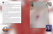 เตือนเที่ยวป่าระวังโรค “สครับไทฟัส”