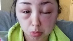 เตือนภัย! แพ้ยาย้อมผม สาวหน้าบวมฉึ่ง ภัยอันตรายที่ต้องระวัง